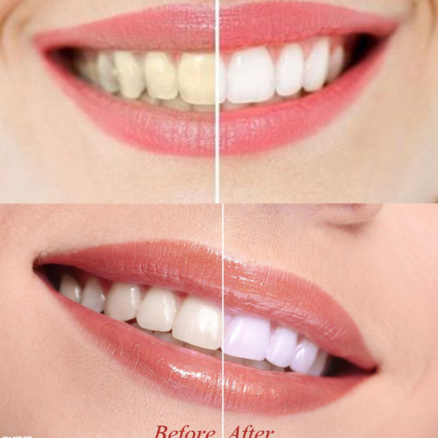 대나무 숯 치아 치아 Dentis Lab 구강 위생 관 - Teeth Whitening Vape 리뷰 및 가격